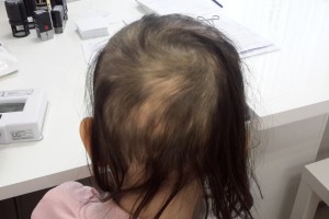 Пациент Э1 (ребенок 9 лет) через 3 месяца лечения. Субтотальная форма очаговой а