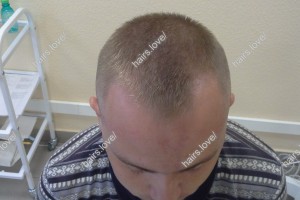 Пациент В до пересадки волос. D.s.: Андрогенная алопеция (Углы Штейна)