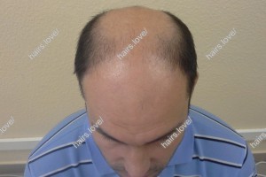 Пациент Е до пересадки волос. D.s.: Андрогенная алопеция 