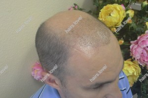 Пациент Е после пересадки волос. D.s.: Андрогенная алопеция 
