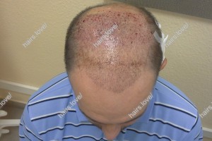 Пациент Е после второй пересадки волос. D.s.: Андрогенная алопеция 