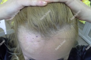 Пациентка А до пересадки волос. D.s.: Коррекция линии роста волос