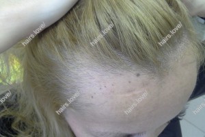 Пациентка А до пересадки волос. D.s.: Коррекция линии роста волос