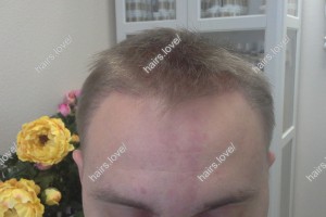 Пациент В после пересадки волос. D.s.: Андрогенная алопеция (Углы Штейна)