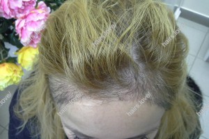 Пациентка А после пересадки волос. D.s.: Коррекция линии роста волос