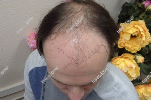 Пациент М до пересадки волос. D.s.: Андрогенная алопеция