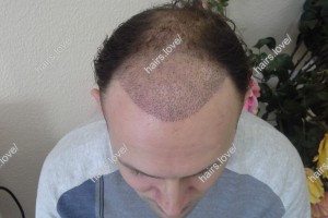 Пациент М через 2 недели после пересадки волос.  D.s.: Андрогенная алопеция