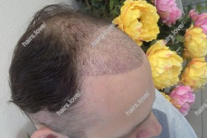Пациент М через 2 недели после пересадки волос. D.s.: Андрогенная алопеция