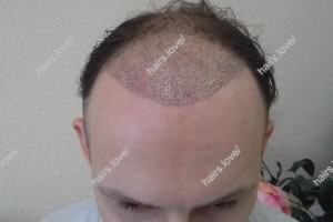Пациент М через 2 недели после пересадки волос.  D.s.: Андрогенная алопеция