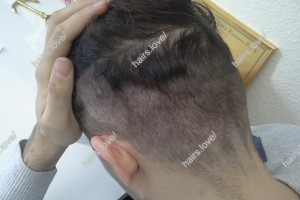 Пациент М. Донорская область (область экстракции), спустя 2 недели после пересадки.