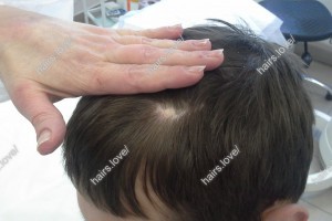 Пациент Л до пересадки волос (рубец)