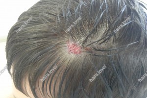 Пациент Л сразу после пересадки волос (рубец)