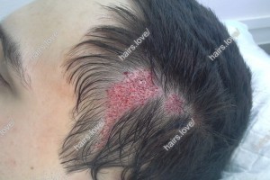 Пациент К  сразу после пересадки волос (рубец)