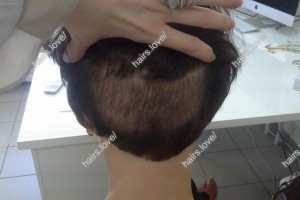 Пациентка Н донорская область через месяц после пересадки волос.