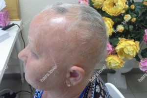 Пациент К (65 лет) через 6 месяцев. Очаговая алопеция.