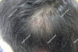 Пациент П через 4 месяца после пересадки волос. Ожог
