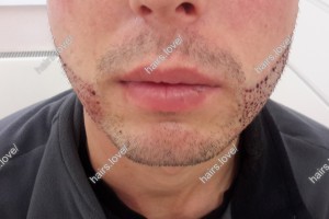 Пациент А сразу после пересадки.
