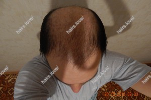 Пациент Е после пересадки волос через (фото сделано самим пациентом)