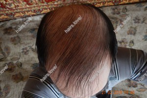 Пациент Е после пересадки волос через 8 месяцев (фото сделано самим пациентом)