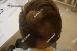 Пациент О (6 лет) через 3 месяца. Рост новых волос. Очаговая алопеция.