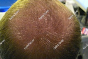 Пациент Д через 1 год после пересадки волос. D.s.: Андрогенная алопеция (Шапочка Кардинала)