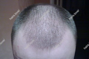 Пациент Ж через 2 недели после пересадки волос. D.s.: Андрогенная алопеция (Углы Штейна)