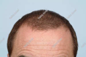 Пациент З после пересадки волос. D.s.: Андрогенная алопеция (Углы Штейна)