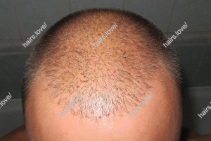 Пациент Ж через 6 месяцев после пересадки волос. D.s.: Андрогенная алопеция (Углы Штейна)
