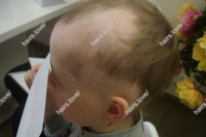 Пациент И через 6 месяцев. Ребенок 10 лет. Очаговая алопеция.