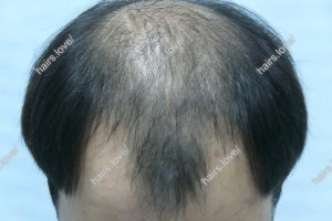 Пациент И до пересадки волос. D.s.: Андрогенная алопеция