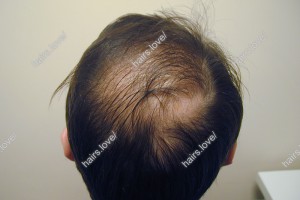 Пациент Г до пересадки волос. D.s.: Андрогенная алопеция (Шапочка Кардинала)