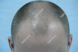 Пациент Ж до пересадки волос. D.s.: Андрогенная алопеция (Углы Штейна)