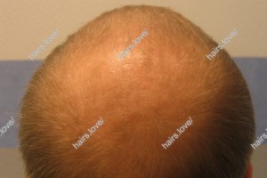 Пациент Д до пересадки волос. D.s.: Андрогенная алопеция (Шапочка Кардинала)