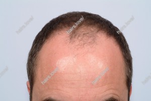 Пациент З до пересадки волос. D.s.: Андрогенная алопеция (Углы Штейна)