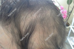 Пациент А через 20 дней. D.s.: Очаговая алопеция (субтотальная форма)