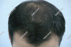 Пациент И через 6 месяев после пересадки волос. D.s.: Андрогенная алопеция 