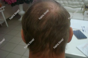 Пациент Л через 2 года.Очаговая алопеция. 