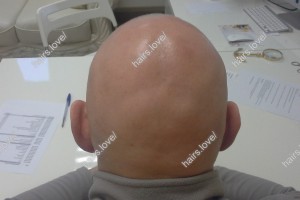 Пациент Л через год.Очаговая алопеция. Стадия обострения.